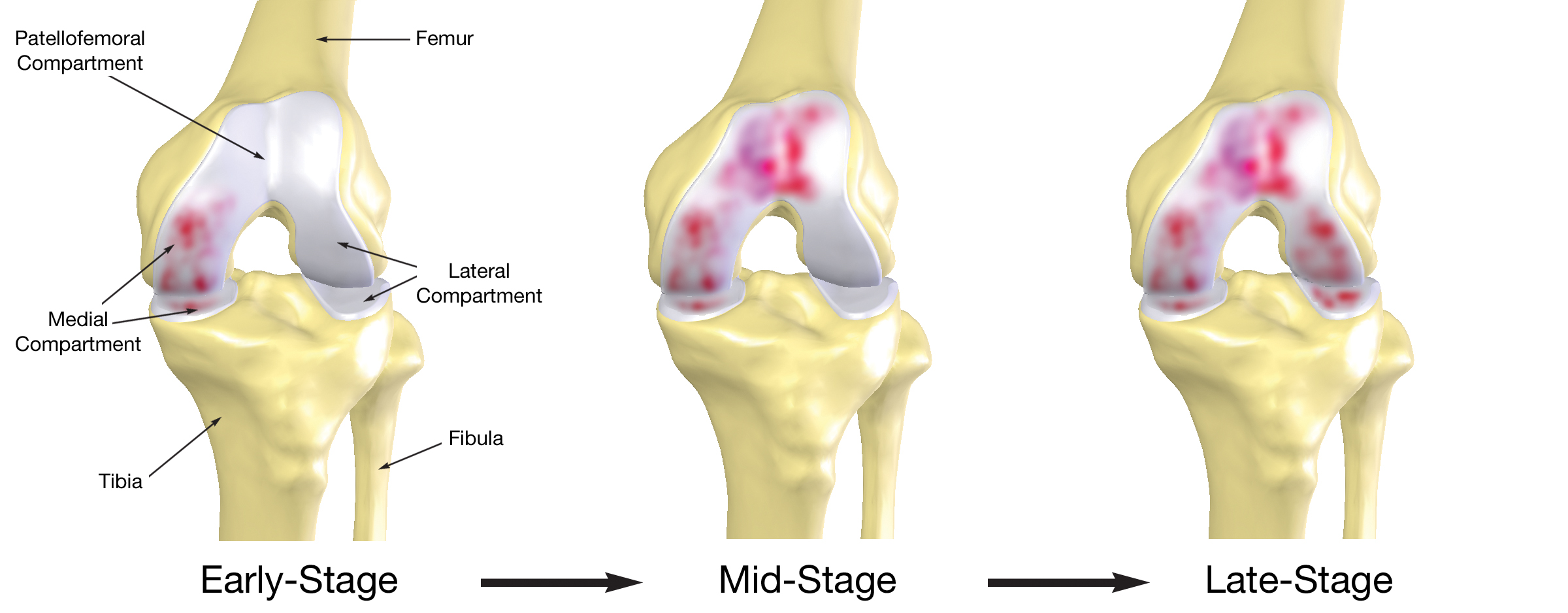 Decay in the knee 