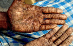 Arsenic in rice and vegetables; public health at risk